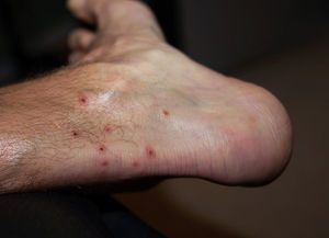 Chigger Bites - What to do when they bite?