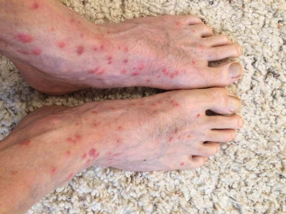 Chigger Bites Feet