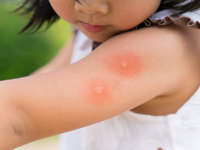 Chigger Bite vs Mosquito Bite