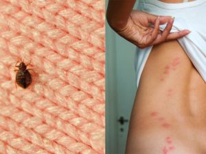 How To Stop Bed Bug Bites From Itching?