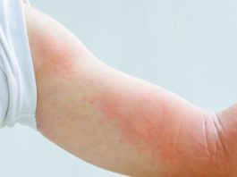  How To Get Rid Of Hives At The Earliest