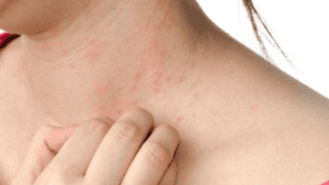  How To Stop Hives From Itching Fast