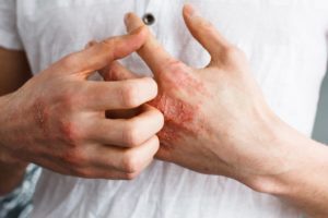 How To Get Rid Of Scabies On Mattress?