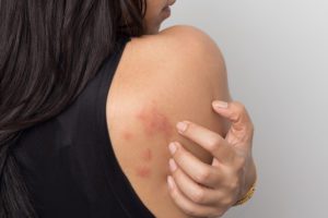  How To Stop Hives From Itching Fast
