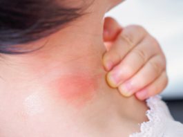 Why Do Mosquito Bites Itch More When You Scratch Them?