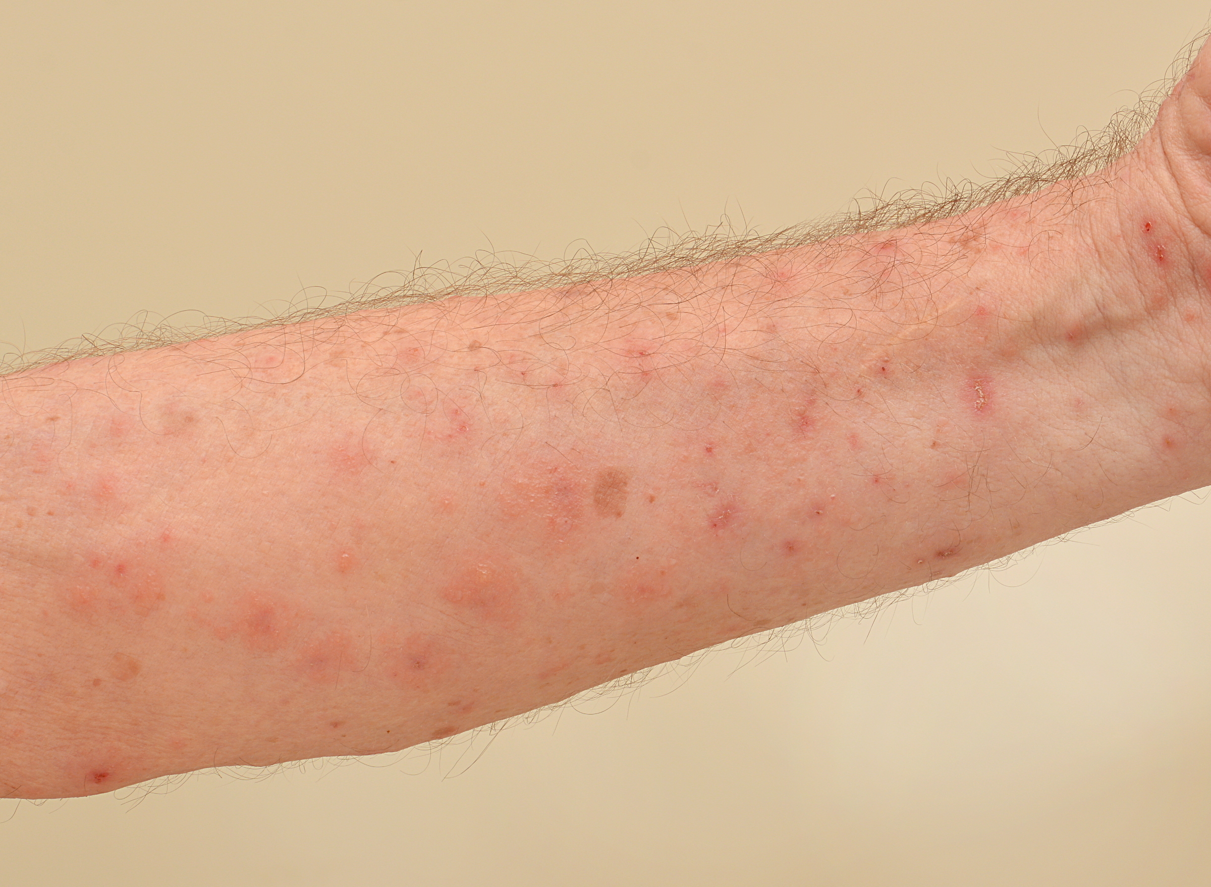 How Long Is Scabies Contagious?