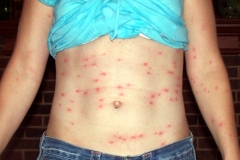 Young girl, with Chigger Bites on her abdomen