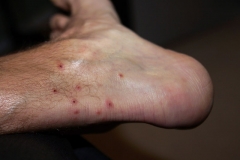Ankle Covered with Chigger Bites