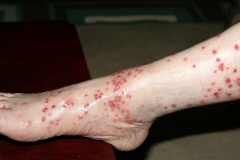 Foot and Lower Leg with Chigger Bites