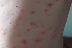 Close-up of Chigger bites