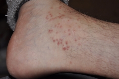 Chigger Bites on the Ankle