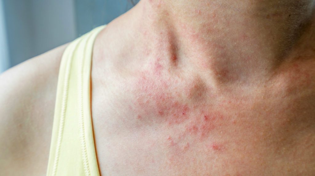 Dust Mite Bites vs Bed Bugs
