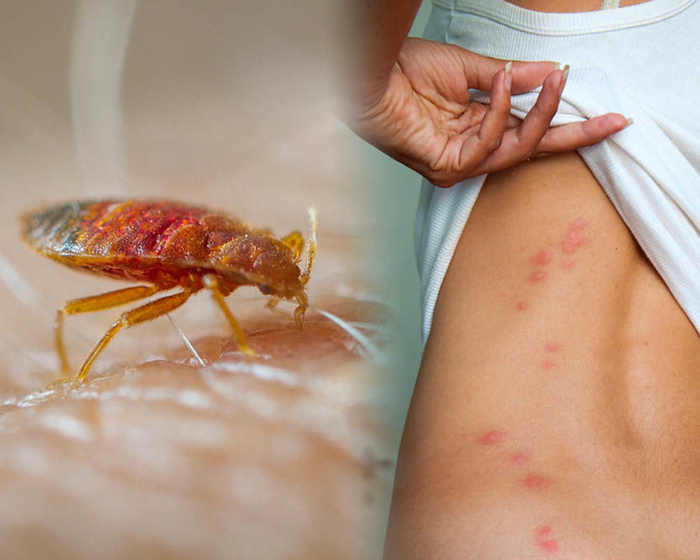 Scabies Vs Bed Bugs Know The Difference Between Them.