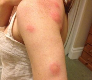 How To Stop Bed Bug Bites From Itching?