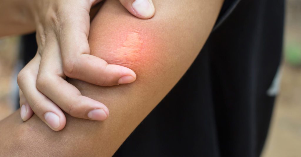 Can You Be Allergic To Mosquito Bites? Check Details Here