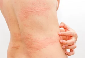 how to get rid of hives