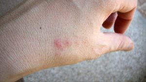 How Long Do Flea Bites Last Generally?