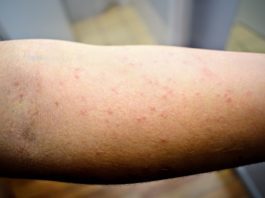 How To Get Rid Of Scabies On Mattress?