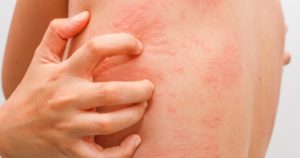 Is Scabies A Sexually Transmitted Disease (STD)?