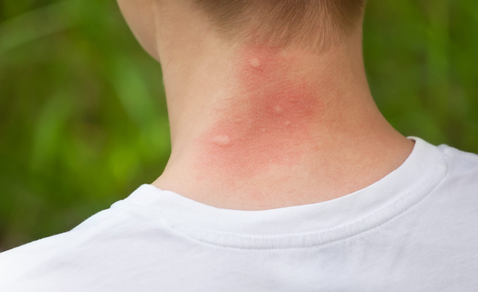 what-do-dust-mite-bites-look-like-check-signs-and-symptoms-here