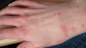 Can You Get Scabies From A Dog?