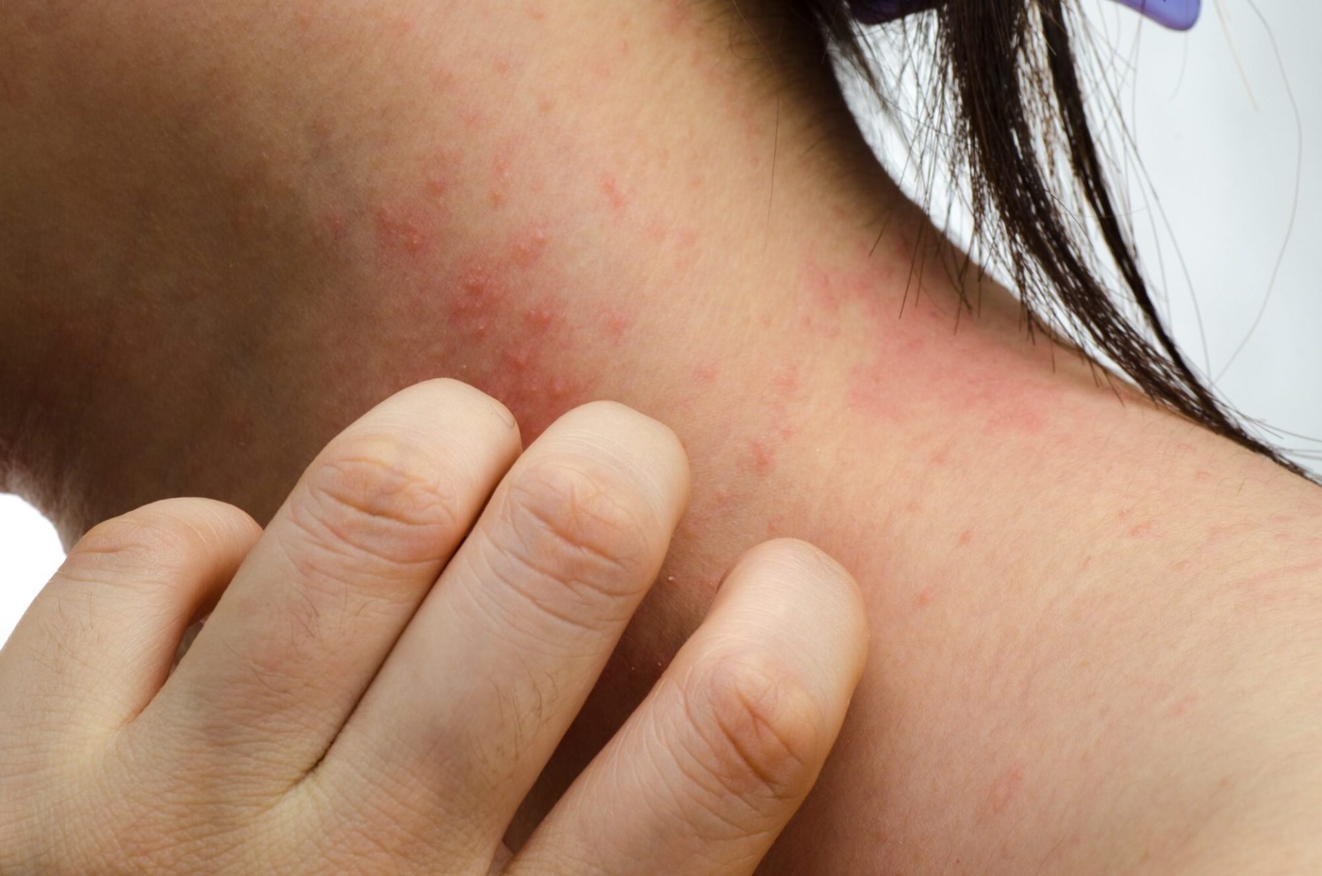 How Long Are Sand Fly Bites Itchy For