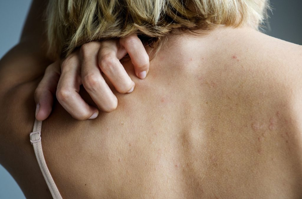 how-to-stop-hives-from-itching-fast-check-effective-treatment