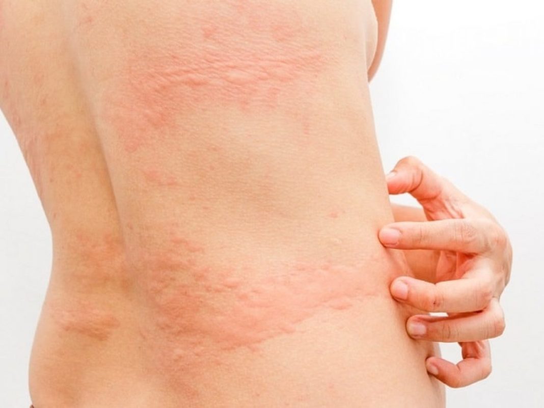 how-to-get-rid-of-hives-hives-cure-to-treat-hives-come-back-to