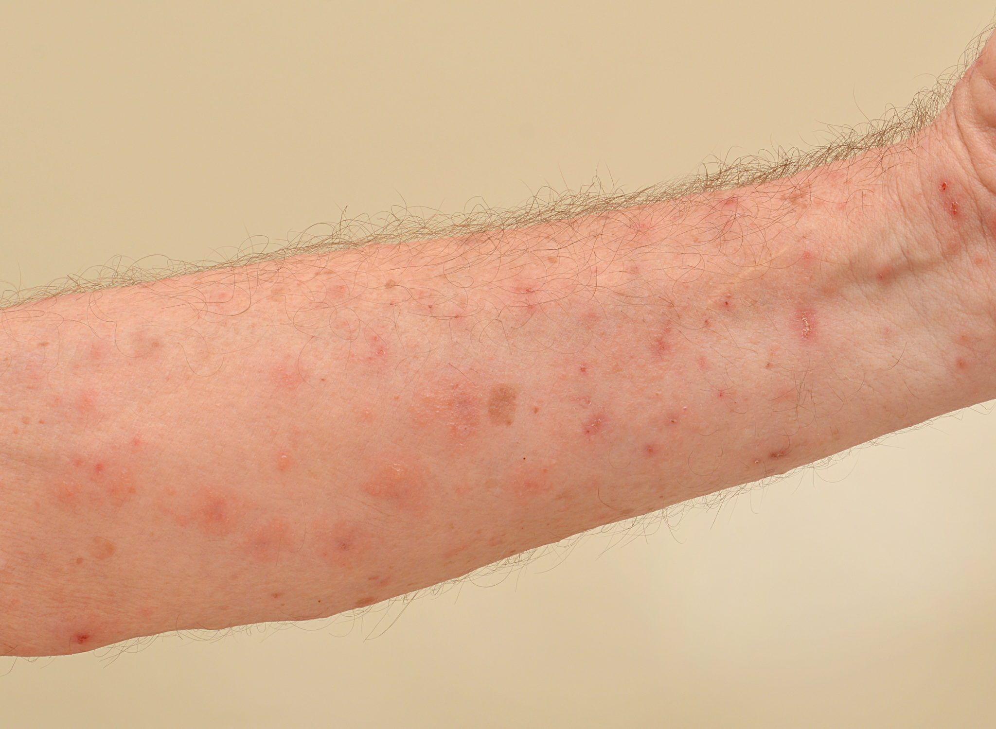 for-how-long-is-scabies-contagious-5-home-remedies