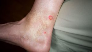 Flea Bites vs Mosquito Bites